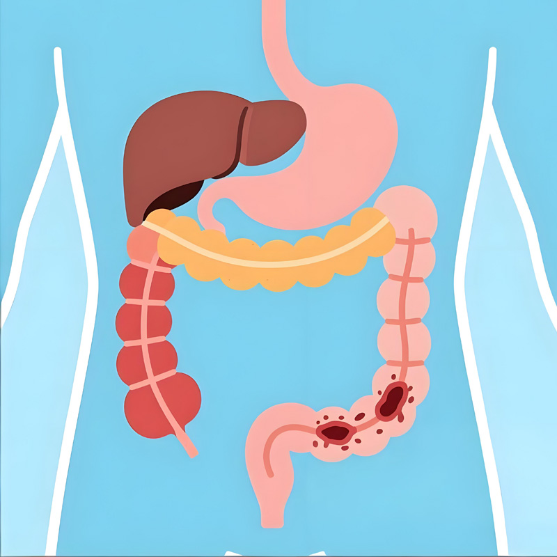 肠道长息肉的4个身体信号，别等肠癌才重视!
