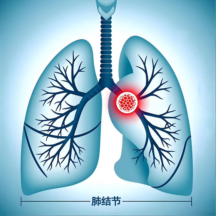 肺结节开始癌变，身体通常会出现这3种症状，早发现早就医