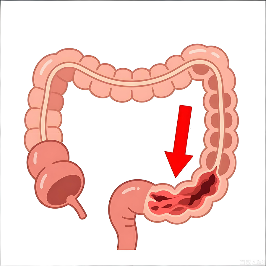 肠梗阻不是小毛病!一文说清典型症状与应对方法